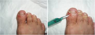 Image result for Paronychia feet
