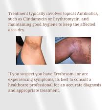 Image result for Erythrasma