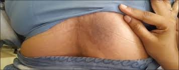 Image result for Notalgia Paresthetica