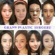 Eyelid And Nose Surgery Hair Transplantation Nose Surgery Surgery Plastic Surgery