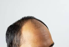 The most common reason for hair loss in both men and women is genetics. Efb Jpnk1 Hlm