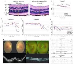 Mutation of SLC7A14 Causes Auditory Neuropathy and Retinitis Pigmentosa  Mediated by Lysosomal Dysfunction