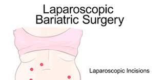 The regular laparoscopic gastric sleeve surgery is not a single incision and generally uses 5 cuts to insert trocars and a laparoscope. Laparoscopic Vs Open Bariatric Surgery