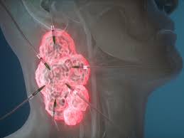 Most head and neck cancers begin in squamous cells. Asp 1929 For Head And Neck Squamous Cell Carcinomas
