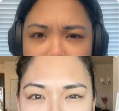 Botox Burlingame, CA