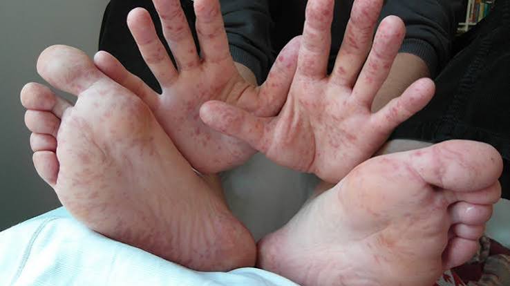 Phát ban ở lòng bàn tay: 8 nguyên nhân và cách điều trị