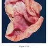 Benign multicystic peritoneal mesothelioma mimicking recurrence of an ovarian borderline tumor: Https Encrypted Tbn0 Gstatic Com Images Q Tbn And9gcsl9gpkmfuq3lru20pgjuugbn0bnvexta3gymxaa4515ppdozcj Usqp Cau