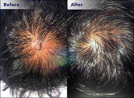Laser therapy irradiates photons into scalp tissues to stimulate hair growth and is the least invasive of the three treatments. Best Hair Treatment Hair Regrowth Hair Implant