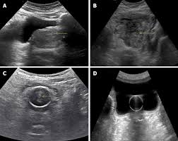 Point Of Care Renal Ultrasonography For The Busy Nephrologist A Pictorial Review