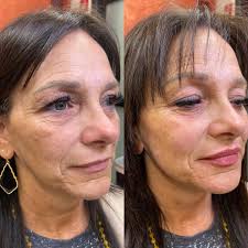 Irene Ware- Nurse Injector