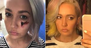 Former The Voice USA contestant Meghan Linsey got bitten by a spider
