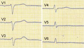 Image result for R Wave