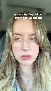 Hans Peterson Accutane