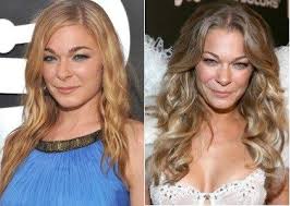 The normal recovery time after heart valve surgery is typically four to eight. Leann Rimes Plastic Surgery Before And After Celebrity Surgeries Celebrity Surgery Plastic Surgery Celebrity Plastic Surgery