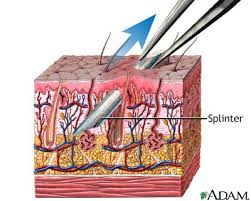 If you don't have any cocaine to numb the area around the splinter you can use solarcaine,oral b,etc. Splinter Removal Medlineplus Medical Encyclopedia