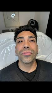 Contorno mandibular, proyección de mentón y relleno de labios con ácido  hialurónico., Dr. Agustín Caceres, MN 176800 MP 235867, #fillers  #ácidohialurónico #contornomandibular #mentón ...