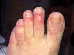 We did not find results for: Unusual Skin Symptoms Of Coronavirus Covid Toes Blisters