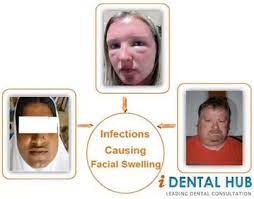 Facial Swelling Due To Tooth Infection Tooth Infection Teeth Abcessed Tooth