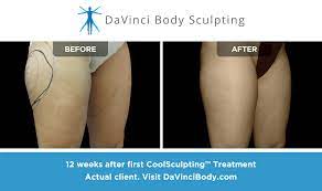 Coolsculpting Outer Thighs Body Sculpting Cool Sculpting Sculpting