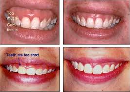 The truth is that there might be more to it than just. Gummy Smile Treatment Long Island Esthetic Gum Contouring