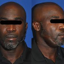 Patient 2 years after excision, reconstruction with an anterolateral...