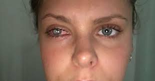 Personal trainer half-blinded after she got a bacterial infection from her  dirty make-up bag