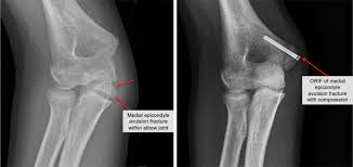 A medial epicondyle fracture is an avulsion injury of the attachment of the common flexors of the forearm. Kid S Elbow Fracture Raleigh Hand Surgery Joseph J Schreiber Md