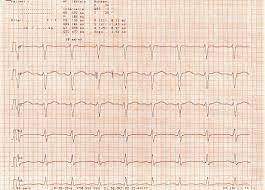 Qt Syndrom Wikipedia
