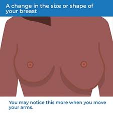 Breast cancer is most treatable when it's found early. Breast Cancer Symptoms Health Information Bupa Uk