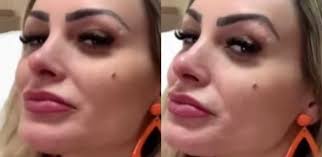 Mais conhecida por ter sido miss bumbum, andressa urach era bem diferente antes da fama, mas o que um silicone, dieta, malhação, plástica e vários outros tratamentos estéticos não são capazes de fazer ? Andressa Urach Faz Preenchimento No Nariz E No Queixo Veja Resultado