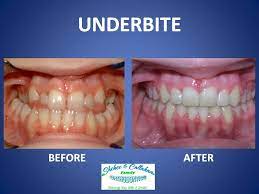 How to fix underbite with braces. Braces Before And After Underbite Braces Before And After Dental Braces Braces