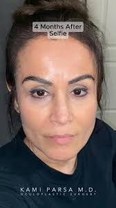 🤳SELFIE UPDATE: 4 Months After Trifecta Lift , This beautiful patient  complained of looking tired due to puffy lower eye bags. We performed our  signature #TrifectaLift to rejuvenate her eyes without ...