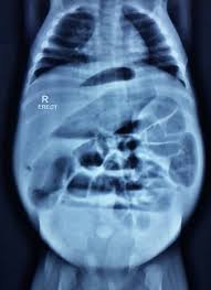 Hirschsprung S Disease In Ahmedabad Hirschsprung S Disease In Gujarat Hirschsprung S Disease In Rajasthan Sparsh Paediatric Surgical Clinic