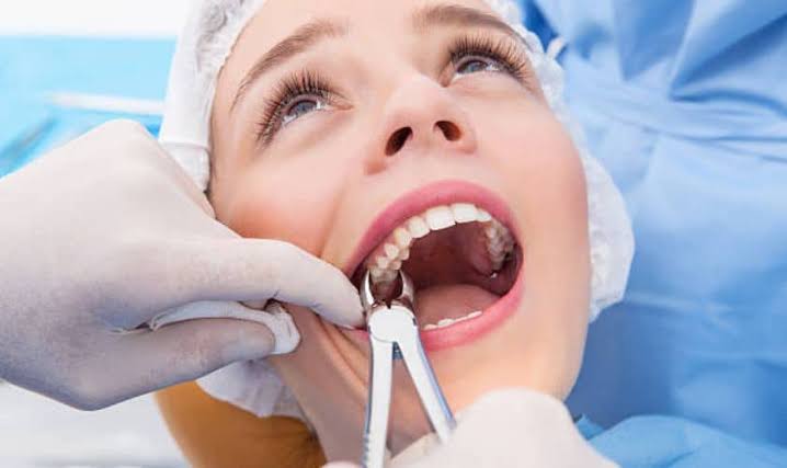 Tooth Extraction