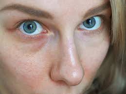 A broken blood vessel in the eye is called a subconjunctival hemorrhage. How To Get Rid Of Broken Capillaries Of The Face Bellatory