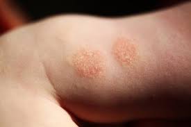 Eczema In Kids What Parents Can Do To Calm The Itch For Parents Us News If your dermatologist suspects that you have dyshidrotic eczema, your dermatologist will image getty images. eczema in kids what parents can do to