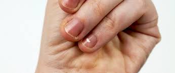 Weisse Flecken Auf Dem Fingernagel Das Ist Die Ursache Rpr1