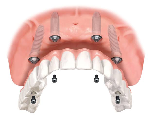 All-on-4 - BFC-Dental