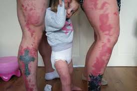 Birthmark On Leg Meaning Awesome Parents Tattoo Their Legs With Daughter S Birthmark So She Won T Feel Different Parent Tattoos Birthmark Tattoo Birthmark