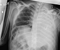 Lung cancer develops due to the overgrowth of. Atelectasis Pulmonary Disorders Merck Manuals Professional Edition