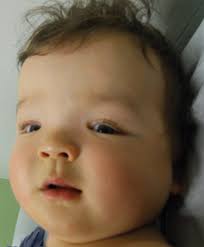 Somatic overgrowth disorders of the PI3K/AKT/mTOR pathway & therapeutic  strategies