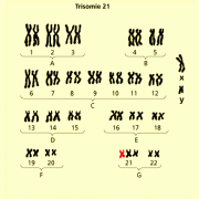 Down Syndrom In Biologie Schulerlexikon Lernhelfer
