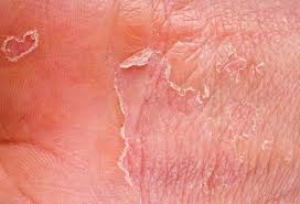 If you've noticed an itchy rash between the folds of your skin, it could be intertrigo. Intertrigo Home Remedies Treatment Symptoms Causes