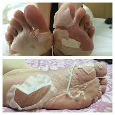 Foto di thick layer of dead skin on feet. Exfoliating Peel Foot Mask Socks Baby Soft Feet Renewal Removes Dead Skin Callus Ebay