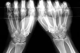 Wrist instability-sportsperformance physiotherapy