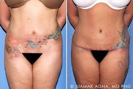 Tummy Tuck Revision Before After Photos Patient 10 Newport Beach