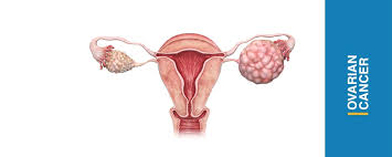 How does one cope with ovarian cancer? Ovarian Cancer All You Should Know Basir Health Tourism Holding