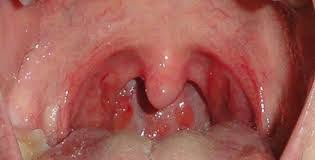 Most throat cancer first signs are visible and persistent. No 1 Silent Killer Cancer Steemkr