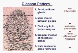 Image result for Prostate Cancer Histologic grading