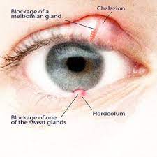 Sty (Stye): Treatment, Causes, 10 Remedies Tips, Symptoms & Pictures